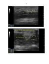 Nghiên cứu hiệu quả giảm đau của truyền liên tục thuốc tê qua Catheter thần kinh đùi cải tiến ở bệnh nhân sau mổ chấn thương đùi và khớp gối