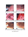 Nhận xét hình ảnh nội soi mô bệnh học của polyp đại trực tràng và kết quả cắt polyp bằng nguồn cắt ENDOPLASMA