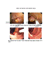 Nhận xét hình ảnh nội soi mô bệnh học của polyp đại trực tràng và kết quả cắt polyp bằng nguồn cắt ENDOPLASMA