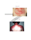 Đánh giá hiệu quả điều trị của truyền TM Cyclophosphamide và Glucocorticoid ở bệnh nhân viêm da cơ có tổn thương phổi kẽ điều trị tại khoa Cơ Xương Khớp Bệnh viện Bạch Mai