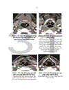 Nghiên cứu đặc điểm lâm sàng chụp cắt lớp vi tính đối chiếu với phẫu thuật của ung thư hạ họng