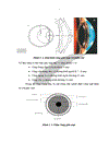 Nghiên cứu điều trị lệch khúc xạ ở trẻ em bằng laser excimer theo phương pháp LASIK 1