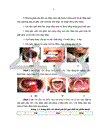 Đánh giá kết quả điều trị gãy góc hàm XHD theo phương pháp Champy phối hợp với nút chỉ thép áp lực 1