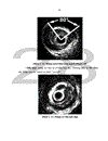 Vai trò của siêu âm trong lòng mạch IVUS trong đánh giá tổn thương mạch vành tại vị trí chia đôi