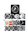 Nghiên cứu đặc điểm hình ảnh và giá trị của chụp cắt lớp vi tính trong chẩn đoán xuất huyết não do tai biến mạch máu não