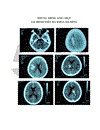 Nghiên cứu đặc điểm hình ảnh và giá trị của chụp cắt lớp vi tính trong chẩn đoán xuất huyết não do tai biến mạch máu não