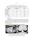 Nghiên cứu giá trị của chụp cắt lớp vi tính trong chẩn đoán chấn thương ống tiêu hóa