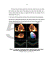 Nghiên cứu tình trạng và mức độ rối loạn đồng bộ tim ở bệnh nhân suy tim bằng phương pháp siêu âm Doppler và Doppler mô