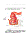 So sánh kết quả điều trị phẫu thuật bệnh trĩ theo hai phương pháp Longo và Milligan Morgan tại bệnh viện Việt Đức năm 2008 2009