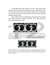 Mô tả đặc điểm hình ảnh và giá trị chẩn đoán của cắt lớp vi tính đối với U quái trung thất