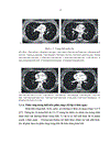 Mô tả đặc điểm hình ảnh và giá trị chẩn đoán của cắt lớp vi tính đối với U quái trung thất