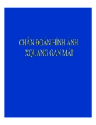 Xquang lồng ngực phổi gan mật cấp cứu bụng 2